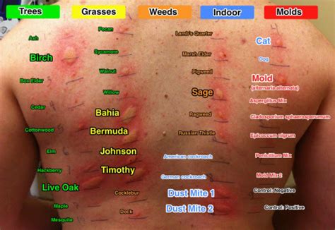 how to read allergy test results